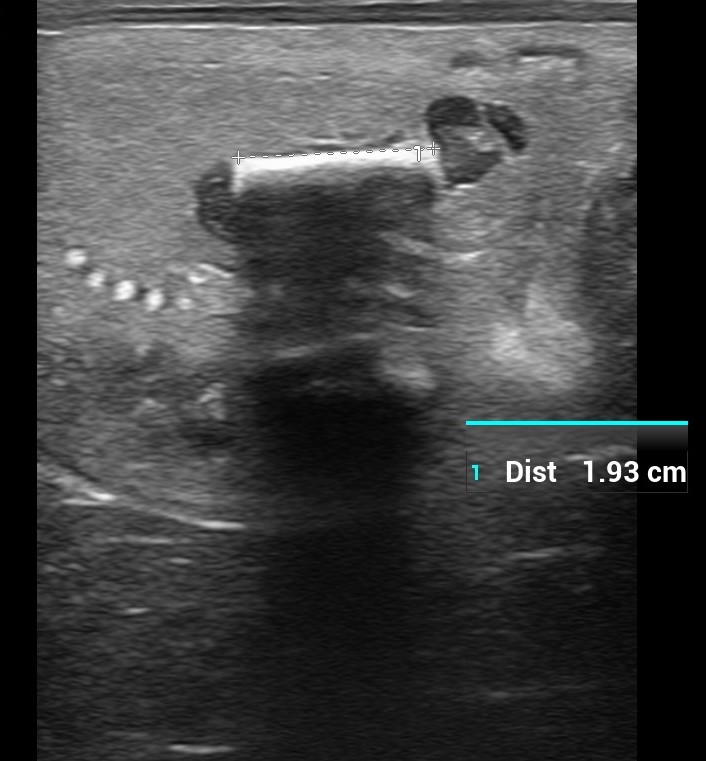 Grayscale ultrasound showing a vertical hypoechoic structure with caliper 1.93 cm