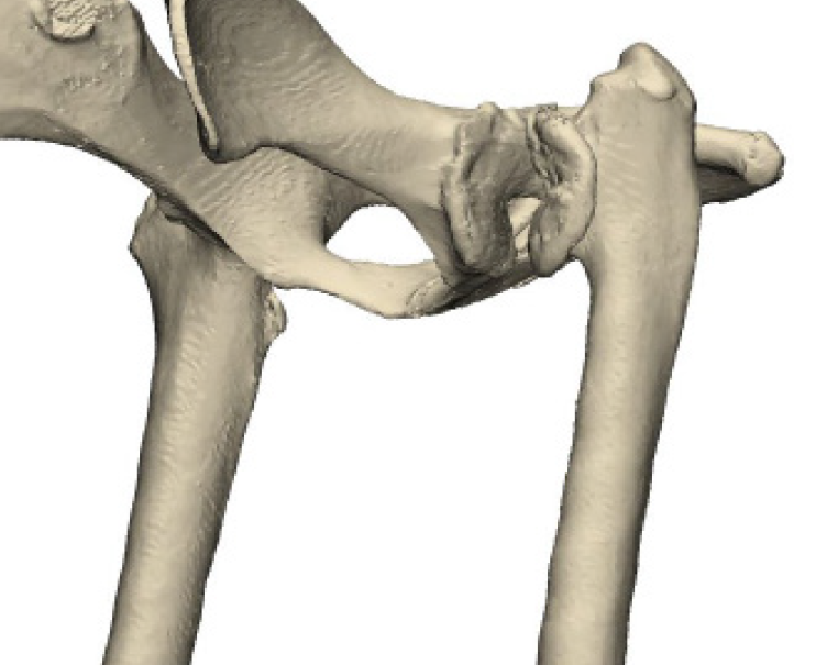 3D rendering of Maddy’s hip joint, note the lack of a “ball and socket” joint